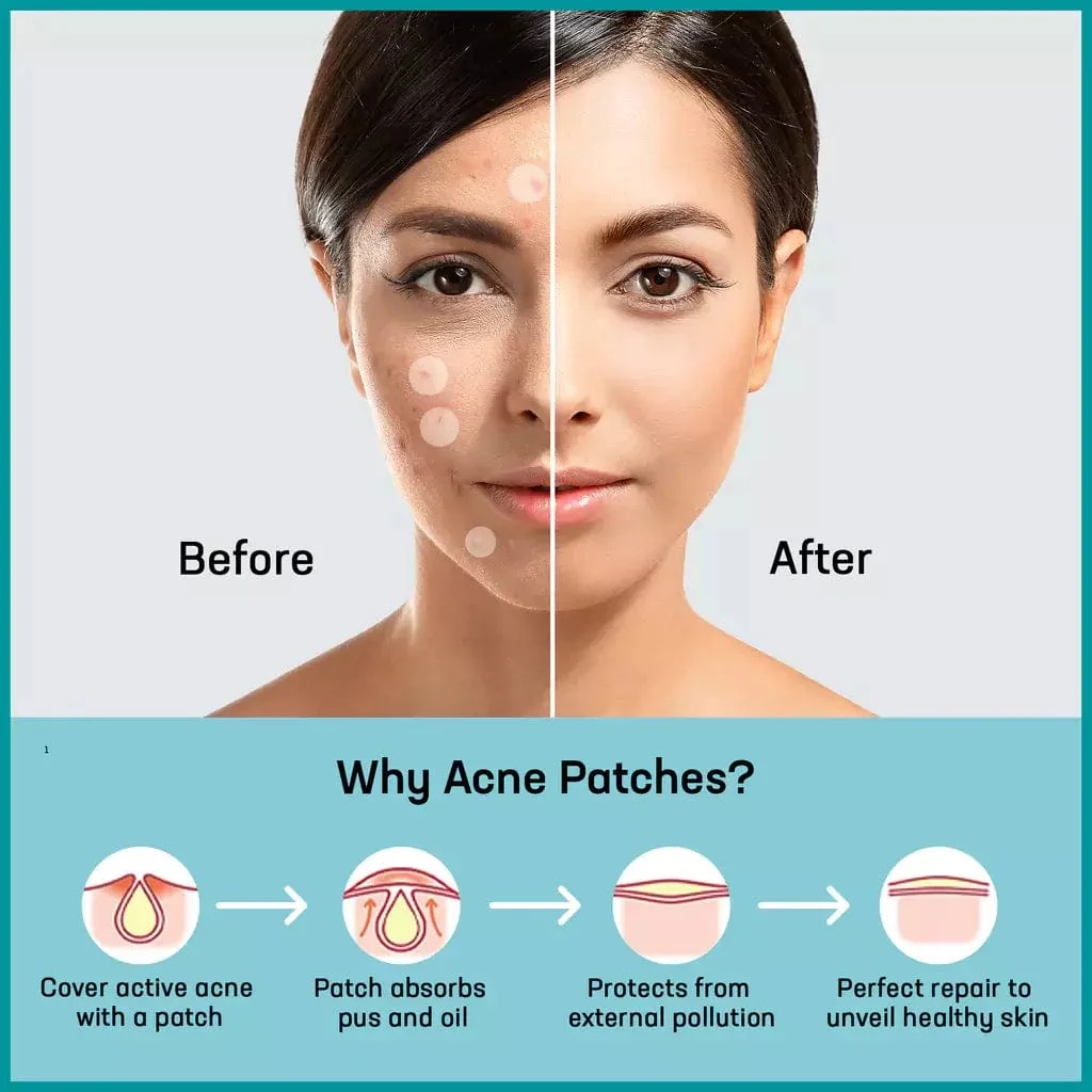 Acne Patch - Pack Of 36 Patches - Image 9