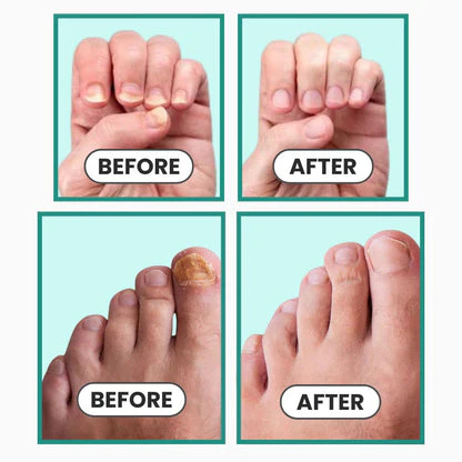 ClearNail Pro™ Nail Fungus Laser Device - Image 3