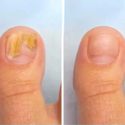ClearNail Pro™ Nail Fungus Laser Device - Image 4