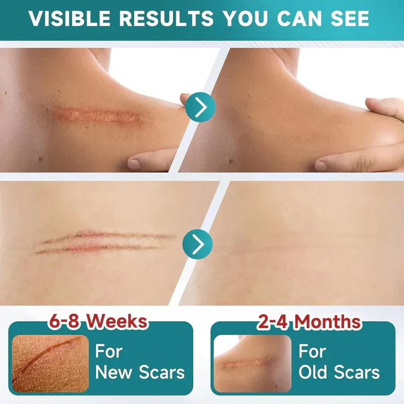 Silicone Scar Remover Tape for Acne & Wrinkles - Image 10